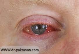 قرمزی چشم همراه با ترشحات آبکی در عفونت ویروسی